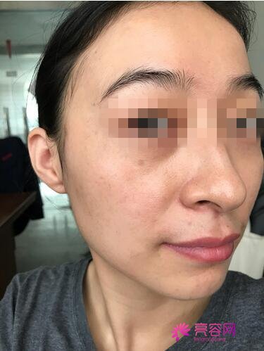 北京臻瑞尚美宋瑜做激光祛斑手术怎么样？案例,价格,口碑