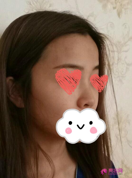 济南芭莎美恩吴院长脂肪填充面部果怎么样?案例,价格,口碑