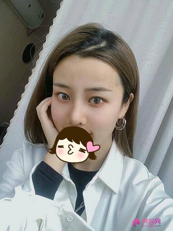 济南芭莎美恩吴院长脂肪填充面部果怎么样?案例,价格,口碑