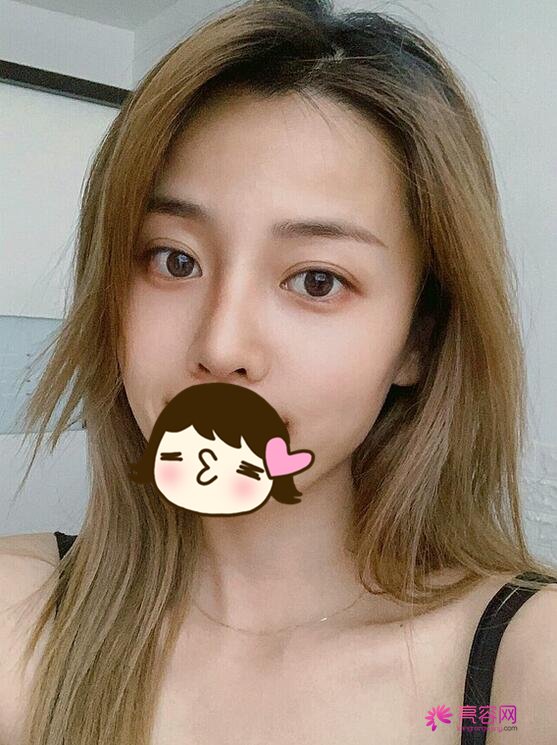 济南芭莎美恩吴院长脂肪填充面部果怎么样?案例,价格,口碑