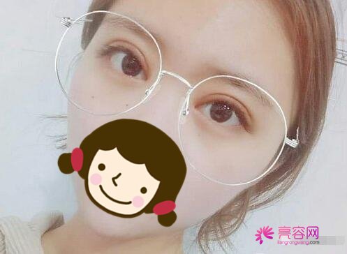 重庆华韩整形唐婷双眼皮果怎么样?案例,价格,口碑