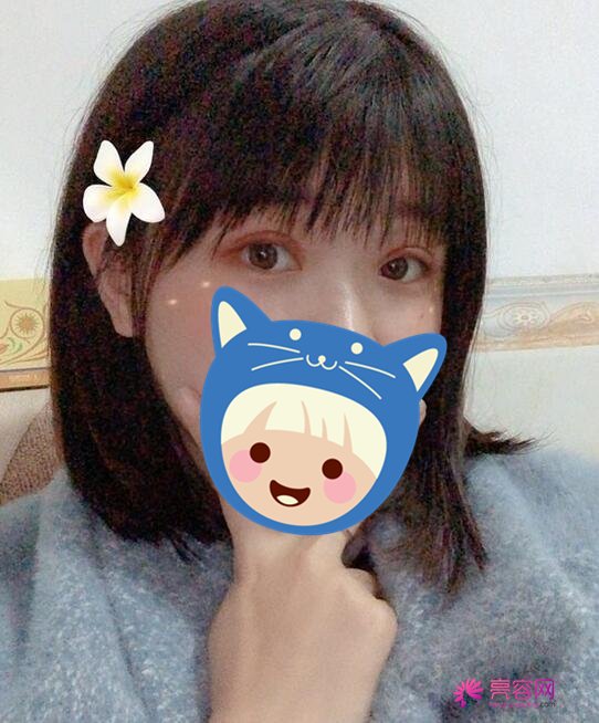 贵阳美贝尔唐振利做双眼皮手术果怎么样?案例,价格,口碑