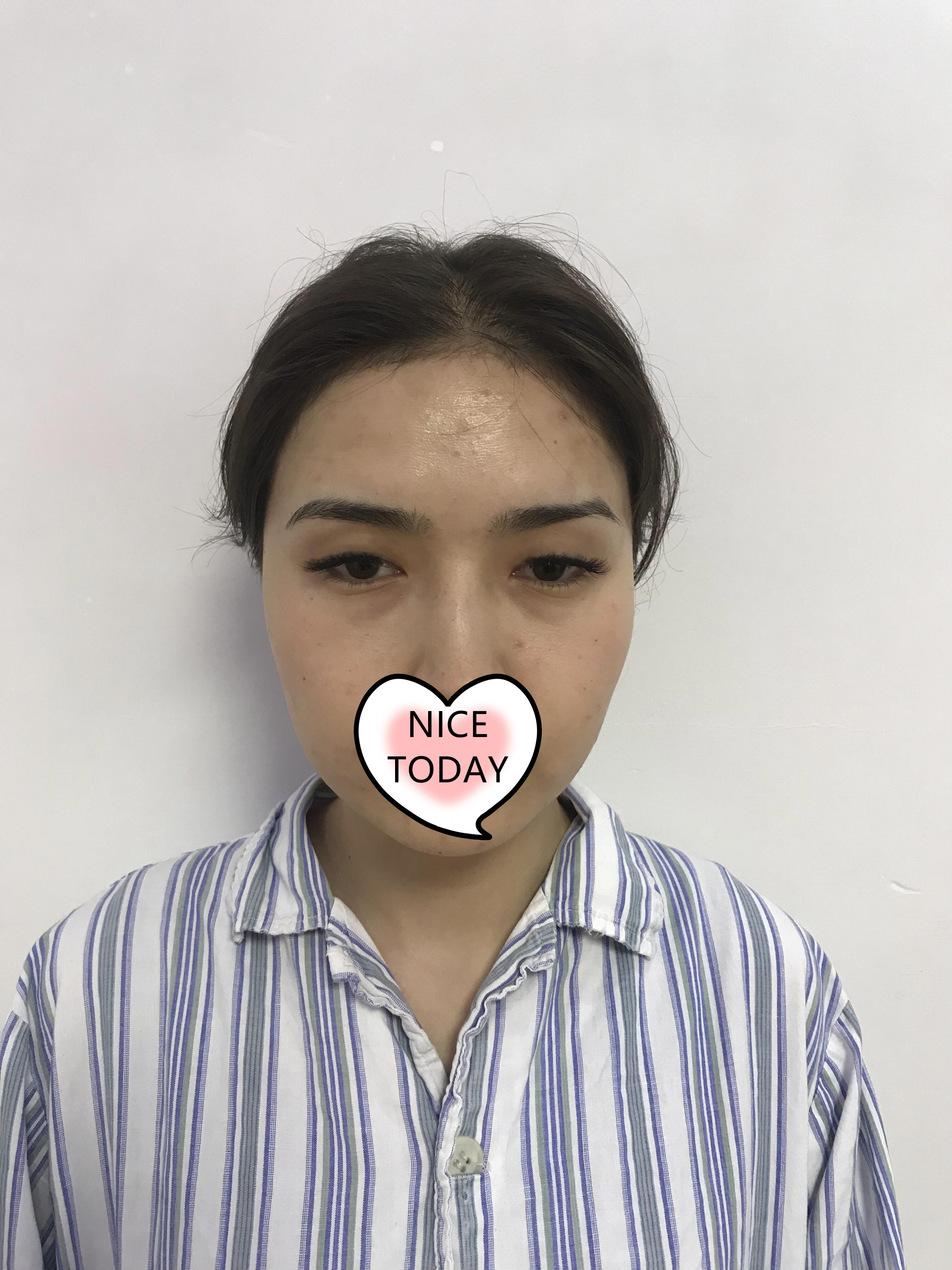 北京美莱谭章梅割双眼皮怎么样?案例,价格