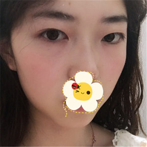 王瑾割双眼皮怎么样?案例,价格