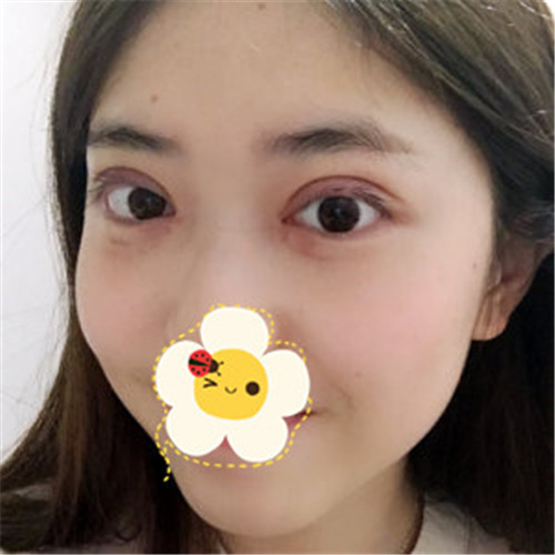 王瑾割双眼皮怎么样?案例,价格