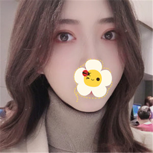 王瑾割双眼皮怎么样?案例,价格