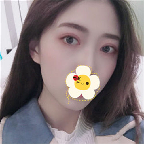 王瑾割双眼皮怎么样?案例,价格