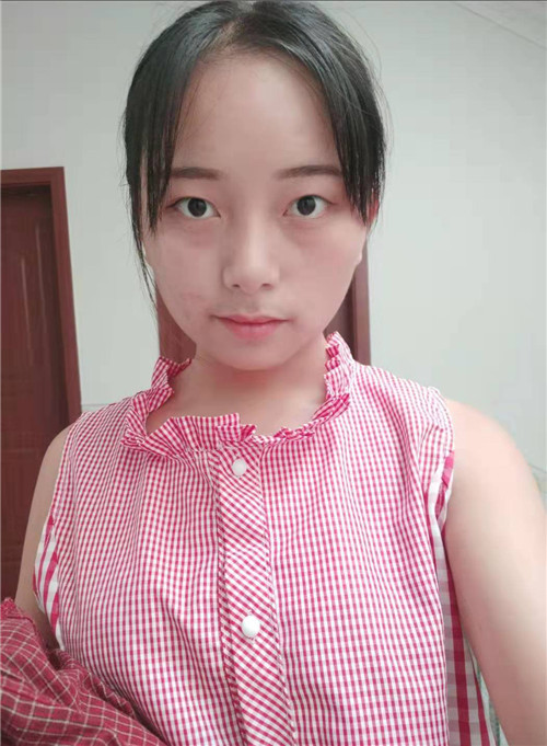 北京延世金奇龙割双眼皮怎么样?案例,价格