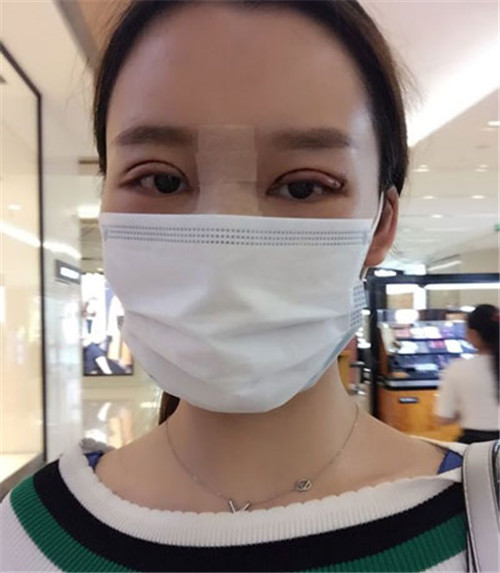 上海华美许再荣割双眼皮怎么样?案例,价格