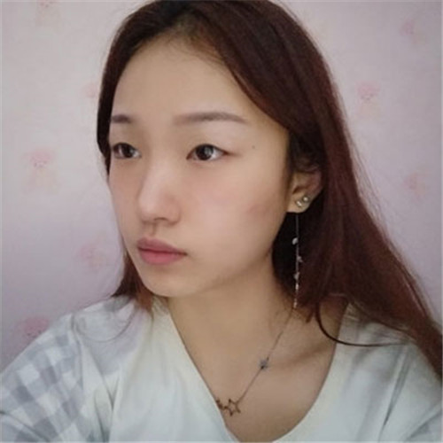 上海华美许再荣割双眼皮怎么样?案例,价格