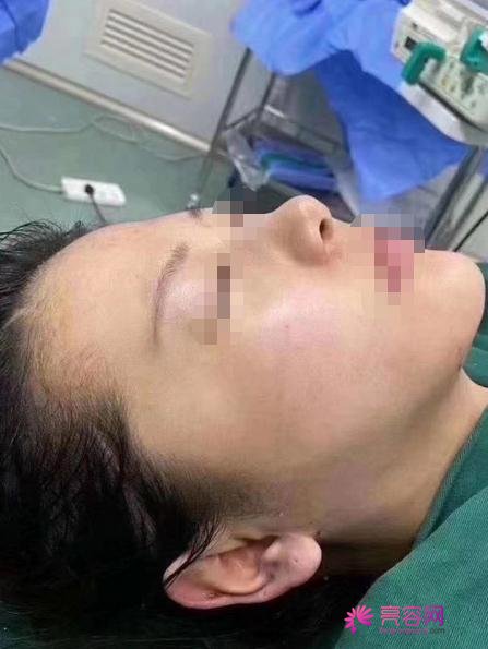 深圳非凡整形罗奇做下颌角怎么样?案例,价格,口碑