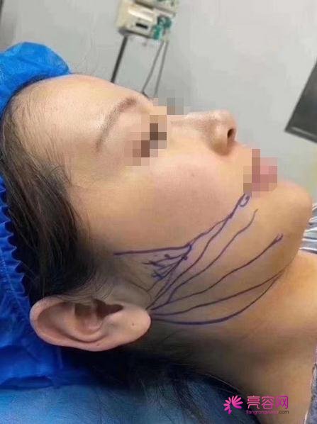 深圳非凡整形罗奇做下颌角怎么样?案例,价格,口碑