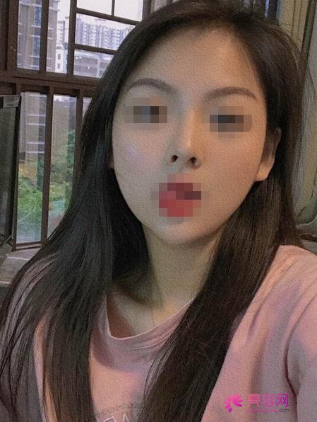 深圳非凡整形罗奇做下颌角怎么样?案例,价格,口碑
