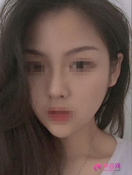 深圳非凡整形罗奇做下颌角怎么样?案例,价格,口碑