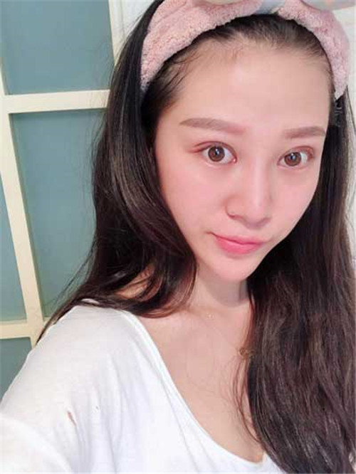 上海华美胡小清割双眼皮怎么样?案例_价格