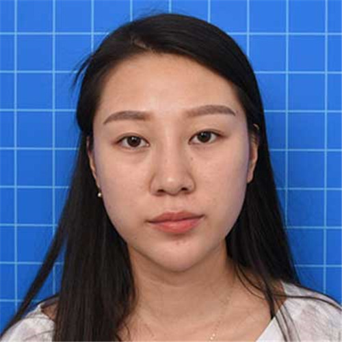 上海华美胡小清割双眼皮怎么样?案例_价格