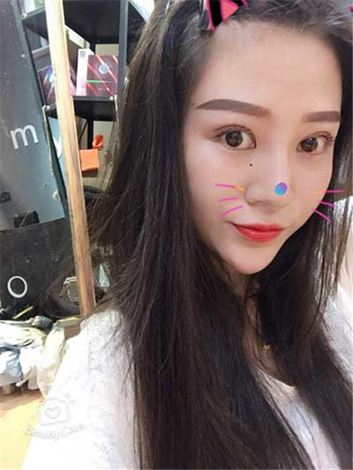 上海华美胡小清割双眼皮怎么样?案例_价格