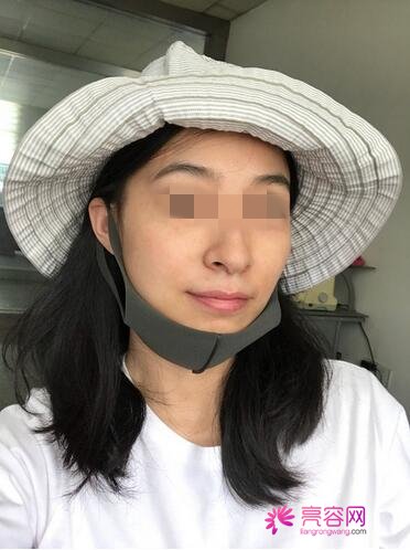 香港V Beauty陈医生做祛斑技术怎么样?案例,价格,口碑