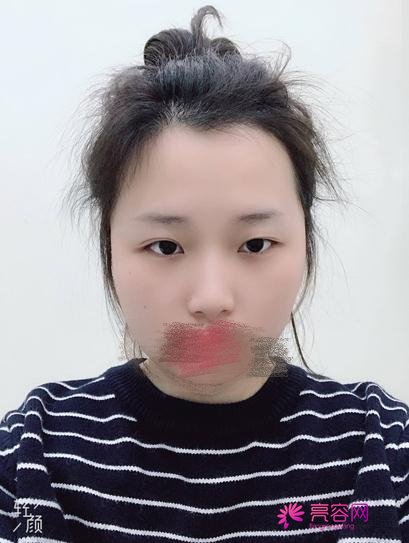 上海第九人民医院余力隆鼻技术怎么样?案例_价格_口碑