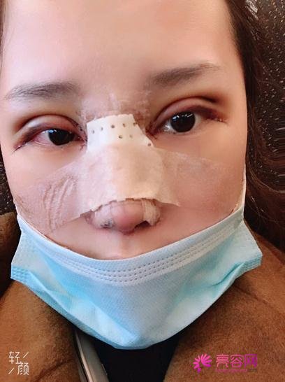 上海第九人民医院余力隆鼻技术怎么样?案例_价格_口碑