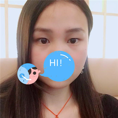 上海伯思立徐晓斐割双眼皮怎么样?案例,价格