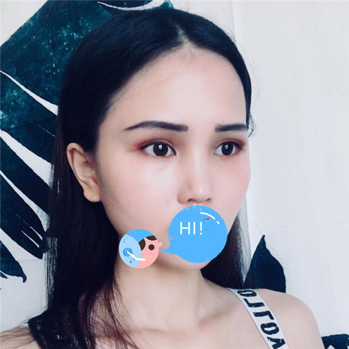 上海伯思立徐晓斐割双眼皮怎么样?案例,价格