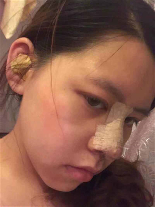 王琳隆鼻怎么样?案例,价格