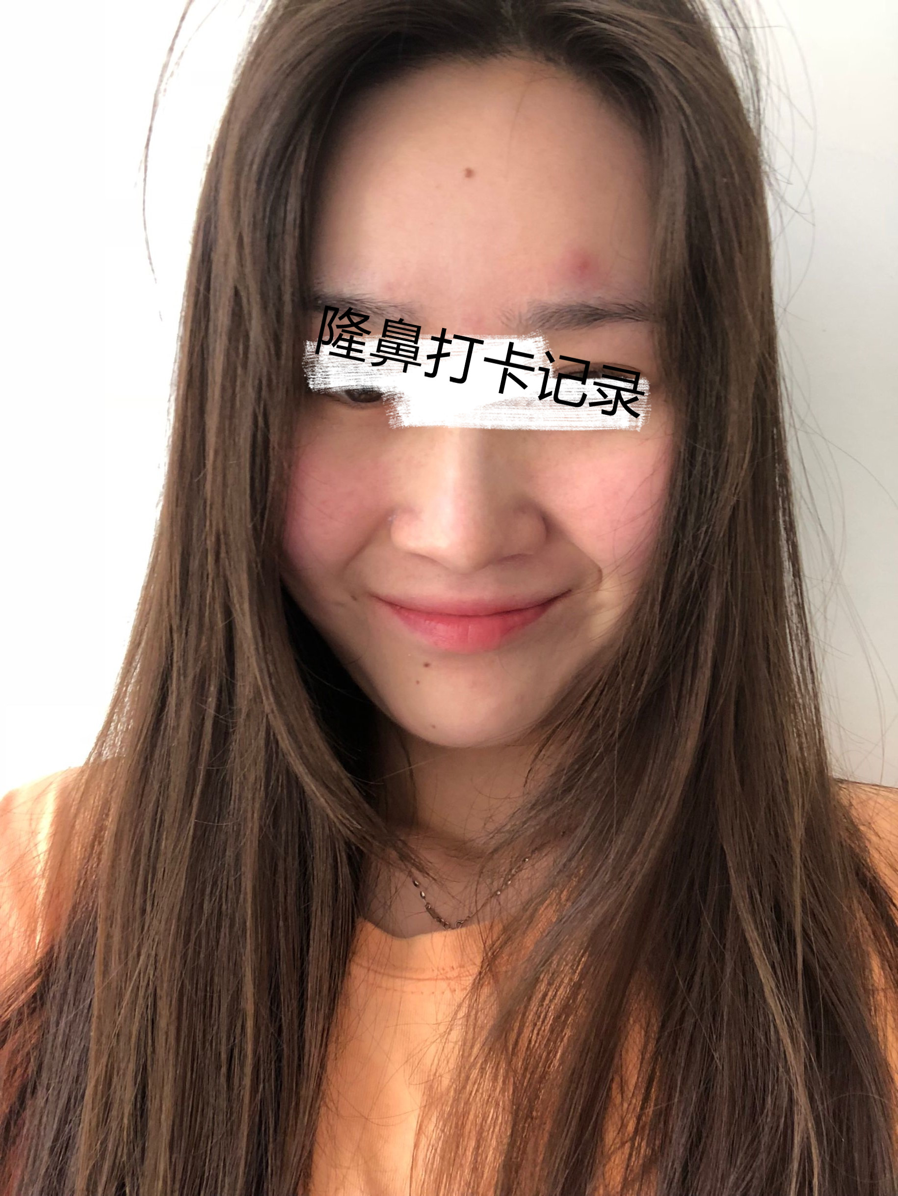 北京画美马群隆鼻怎么样?案例,价格