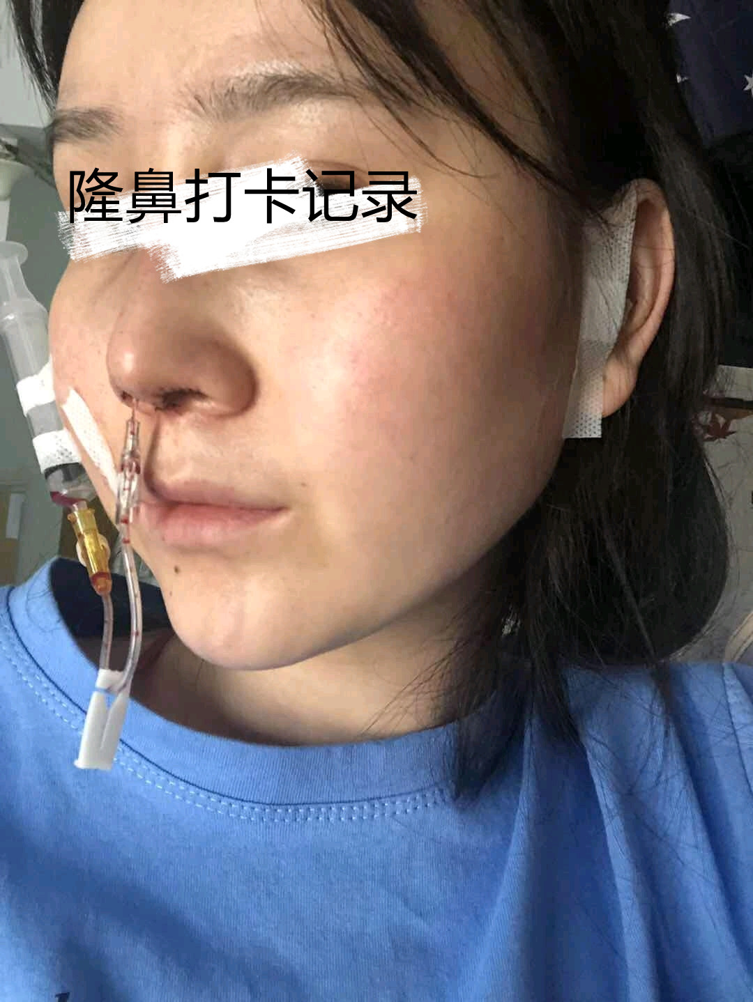 北京画美马群隆鼻怎么样?案例,价格