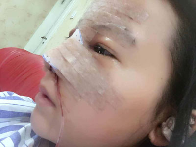 北京画美徐学东隆鼻怎么样?案例_价格