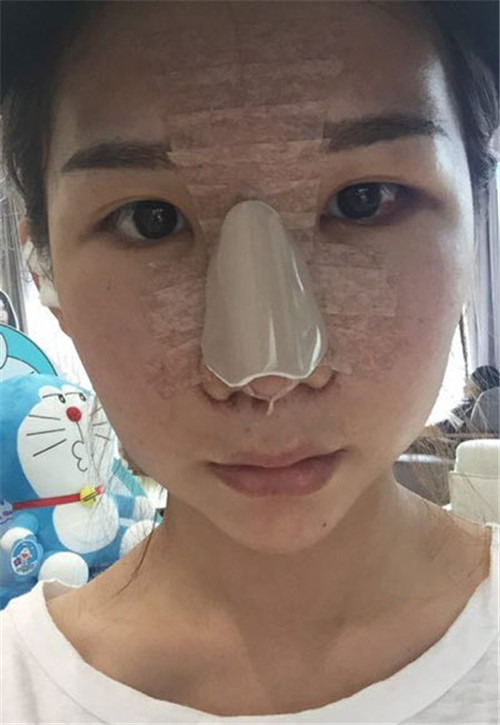 黄惠真隆鼻怎么样?案例_价格