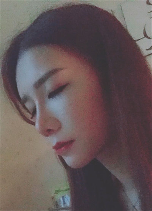 黄惠真隆鼻怎么样?案例_价格