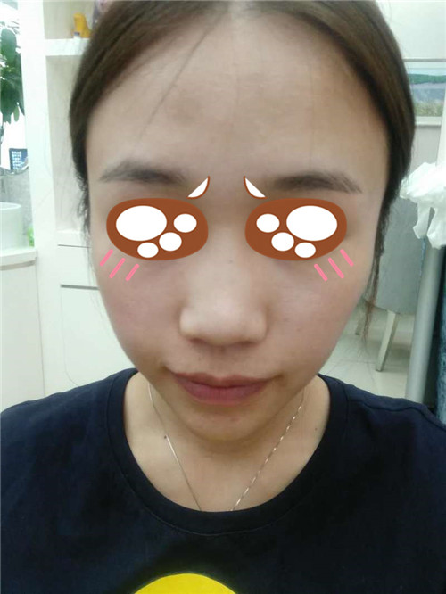 北京美莱牛勇敢隆鼻怎么样?案例,价格