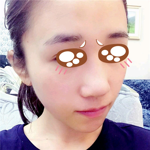 北京美莱牛勇敢隆鼻怎么样?案例,价格