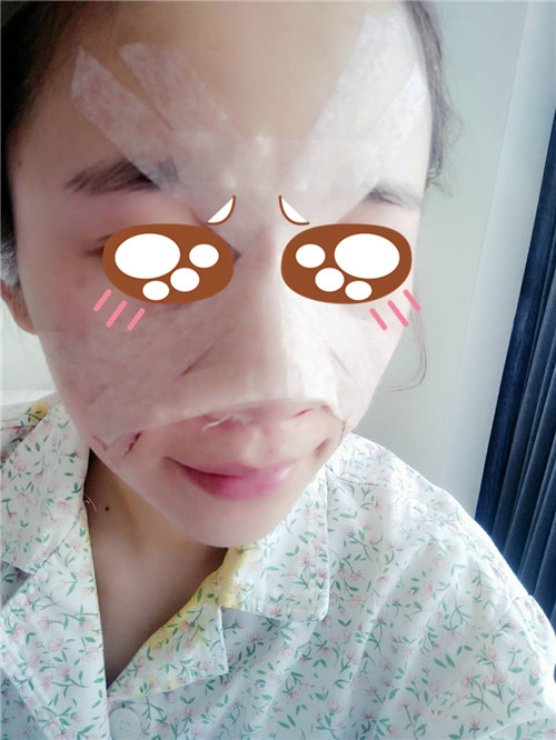 北京美莱牛勇敢隆鼻怎么样?案例,价格