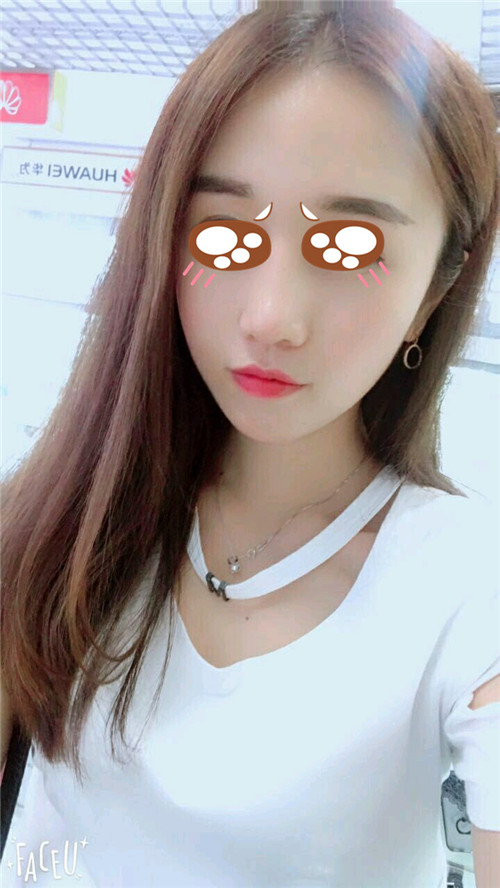 北京美莱牛勇敢隆鼻怎么样?案例,价格
