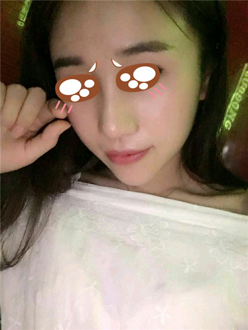 北京美莱牛勇敢隆鼻怎么样?案例,价格