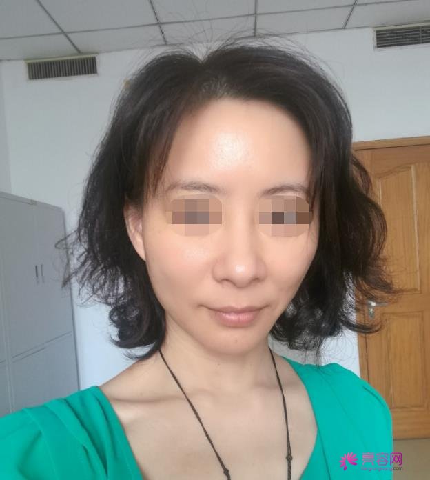 哈尔滨诺嬄美整形医院李丽丽做热玛吉怎么样？案例,价格,口碑