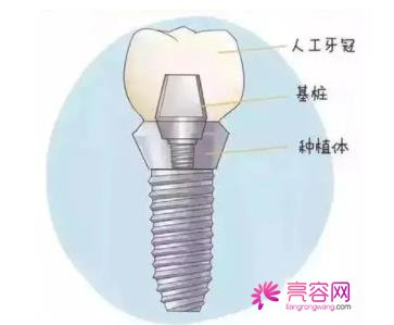 成都龙普兰特口腔王晓霞做牙齿矫正怎么样？案例_价格_口碑