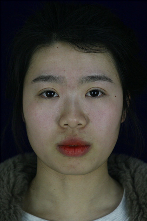 北京美莱王旭东隆鼻怎么样?案例,价格