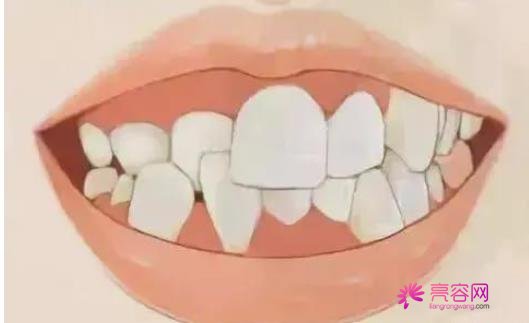 整牙的年龄限制是多少？成年人还可以做牙齿矫正吗？正畸原理介绍