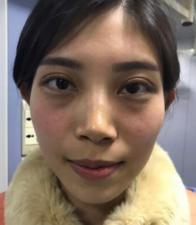 北京韩啸姜辉自体脂肪移植怎么样?案例,价格