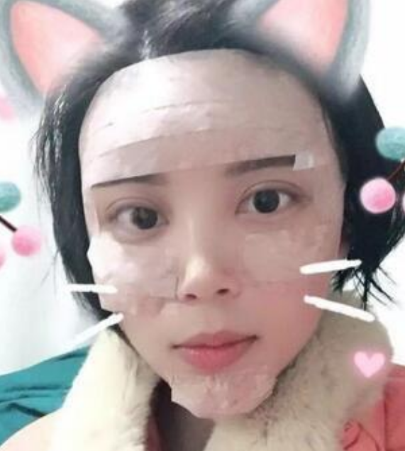 北京韩啸姜辉自体脂肪移植怎么样?案例,价格