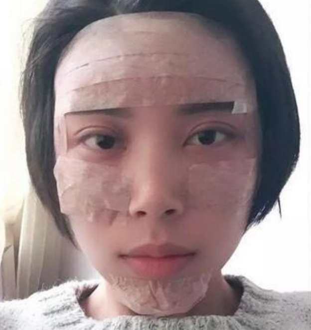 北京韩啸姜辉自体脂肪移植怎么样?案例,价格