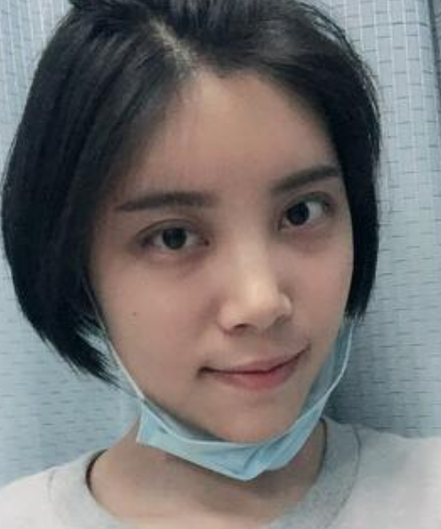 北京韩啸姜辉自体脂肪移植怎么样?案例,价格