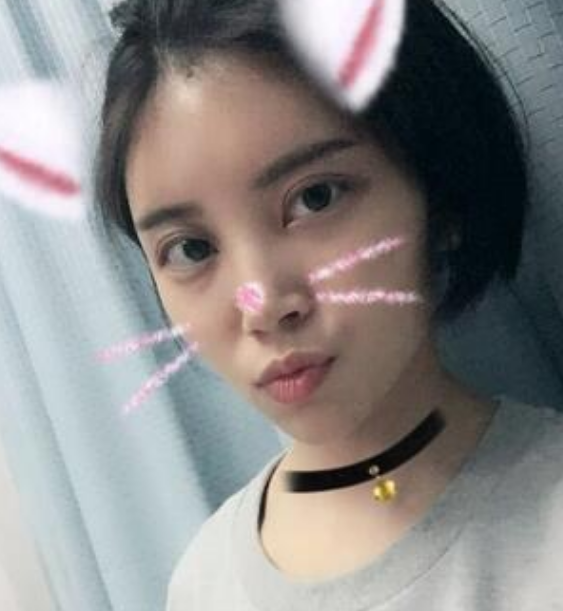 北京韩啸姜辉自体脂肪移植怎么样?案例,价格