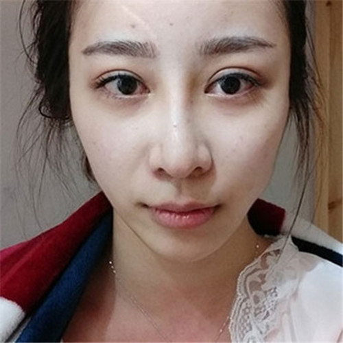 上海薇琳张怀军自体脂肪移植怎么样?案例,价格