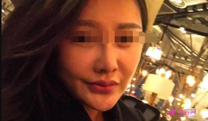 武汉同济医院整形美容科吴敏医生做脸部填充怎么样？案例_价格_口碑