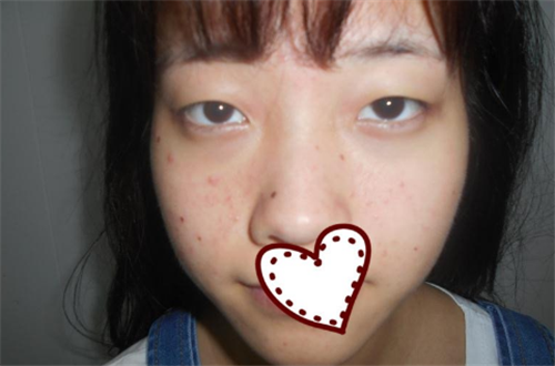 北京爱悦丽格陈波割双眼皮怎么样?案例_价格