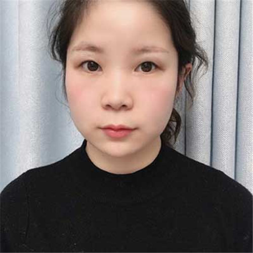 上海艺星杨国正割双眼皮怎么样?案例价格